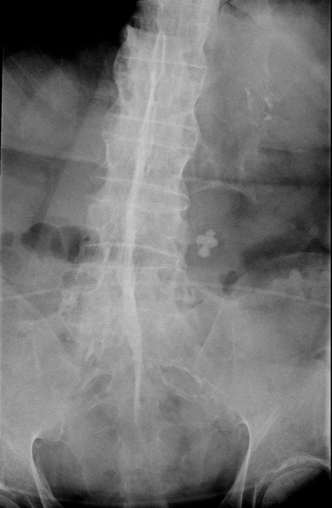 lumbar-spine-aortic-calcification-lumbar-spine